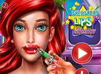 Sirena Injectie in Buza